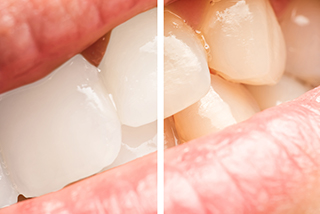 歯の黄ばみやくすみを解消するホワイトニング