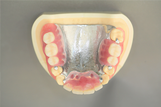 取り扱い入れ歯（自費）の種類の一例
