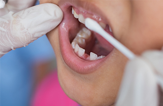 乳歯は特に虫歯の進行が早いので注意しましょう