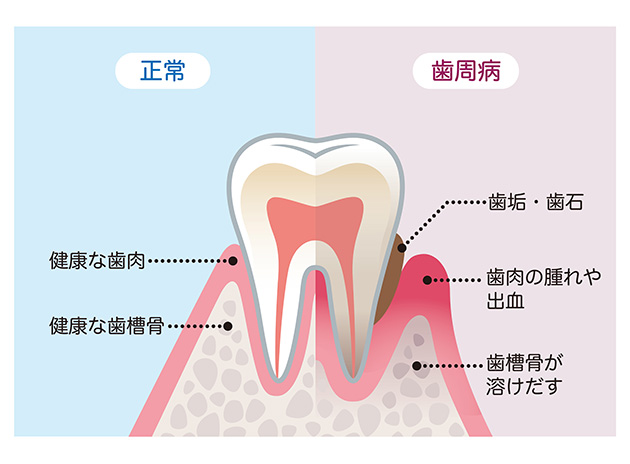 患者さんの口腔内状況に合わせた予防治療