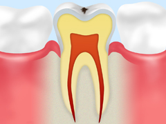 C0　初期虫歯