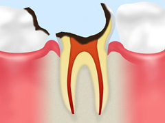 C4　歯根に達した虫歯